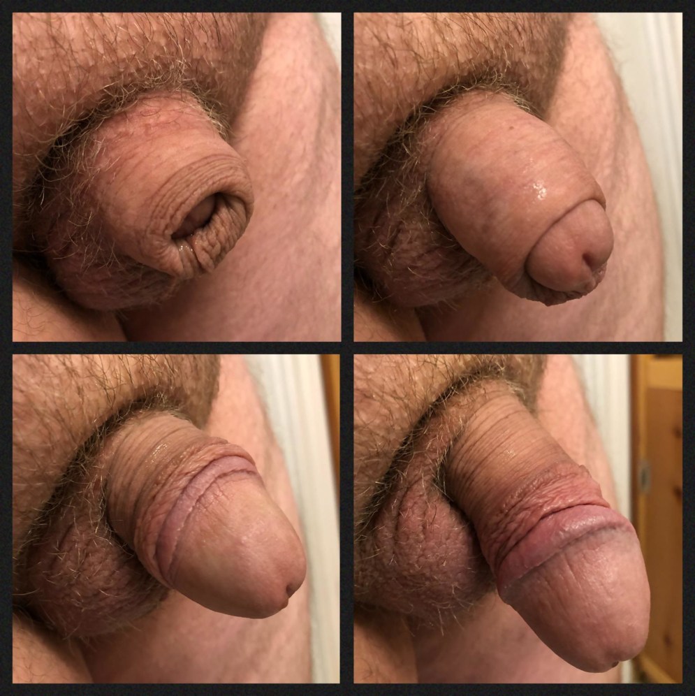 Girls Clitless Circumcised Model Anal