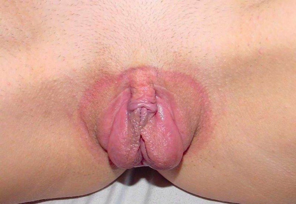 A large hood of the clitoris